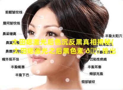 太田痣激光后色沉反黑真相揭秘(太田痣激光之后黑色素 🦋 排出的过程是多久)